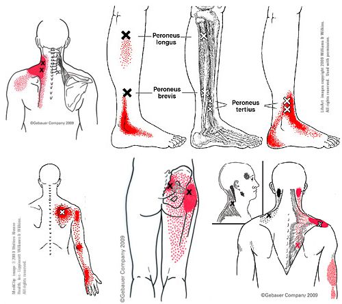 Trigger Point Referred System 